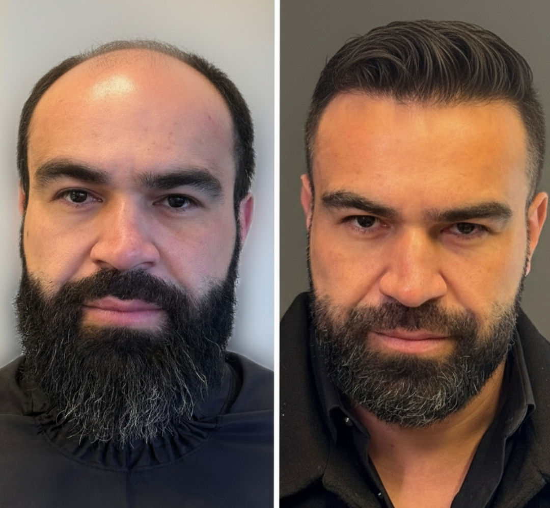 Antes e Depois de Guilherme Ferreira